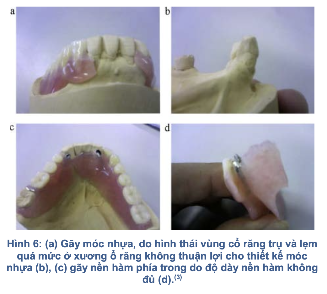 Hàm nhựa dẻo trong phục hình tháo lắp: Đặc tính, chỉ định và biến chứng lâm sàng